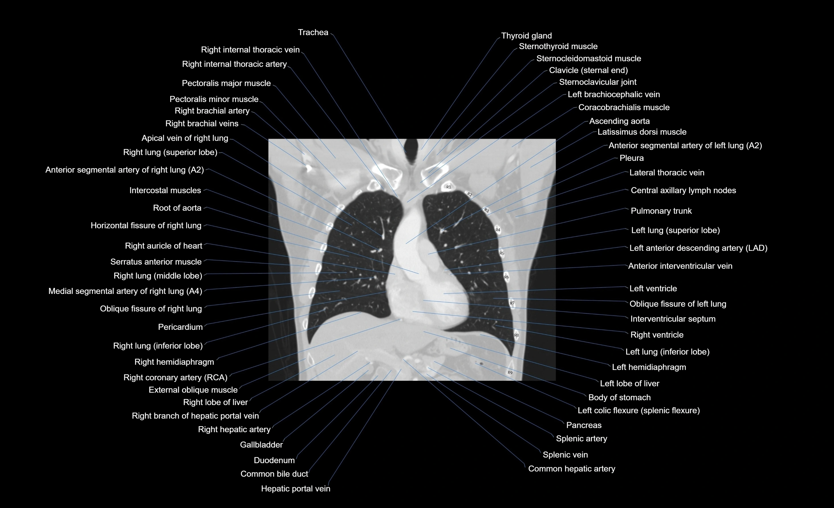 CT chest (thorax) lung window window labelled coronal cross sectional anatomy radiology image-00076.webp